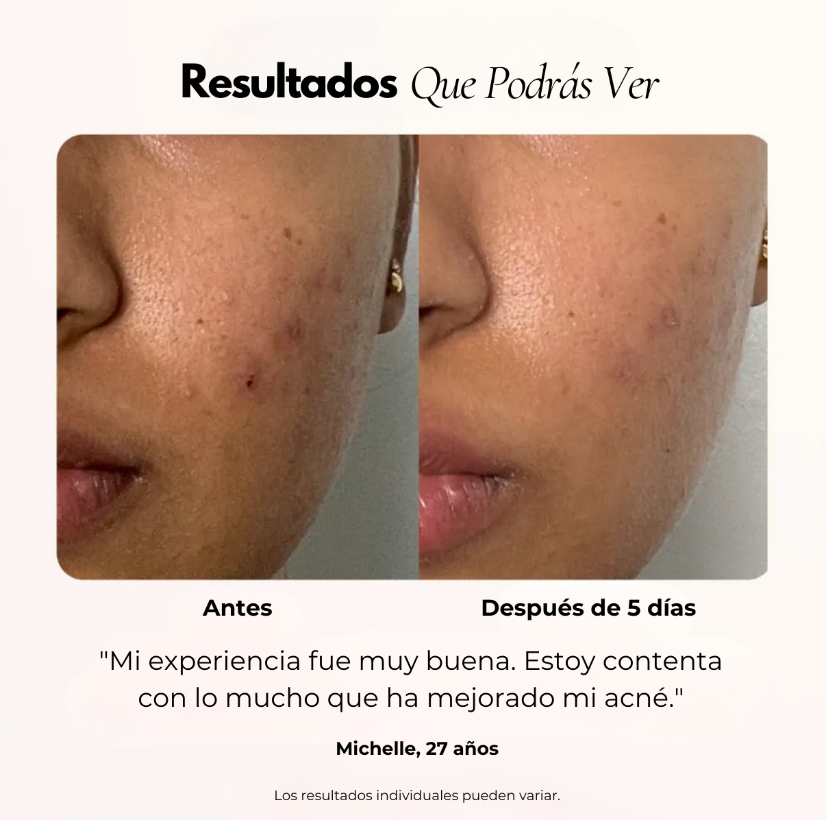 Bye Acné QSKIN kit completo tratamiento anti acné