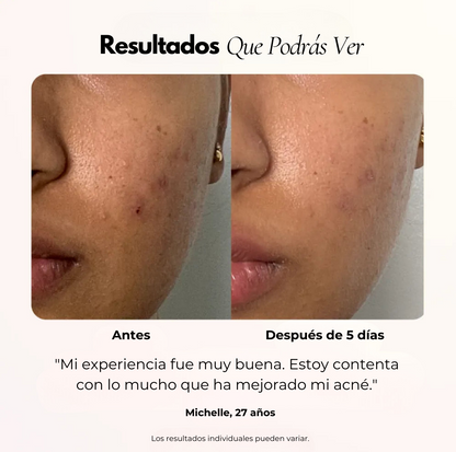 Bye Acné QSKIN kit completo tratamiento anti acné