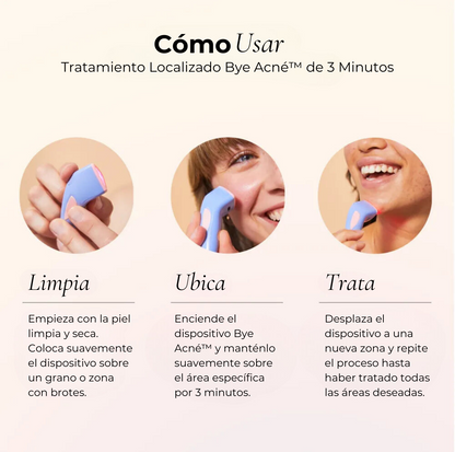 Bye Acné QSKIN dispositivo compacto tratamiento espinillas Chile