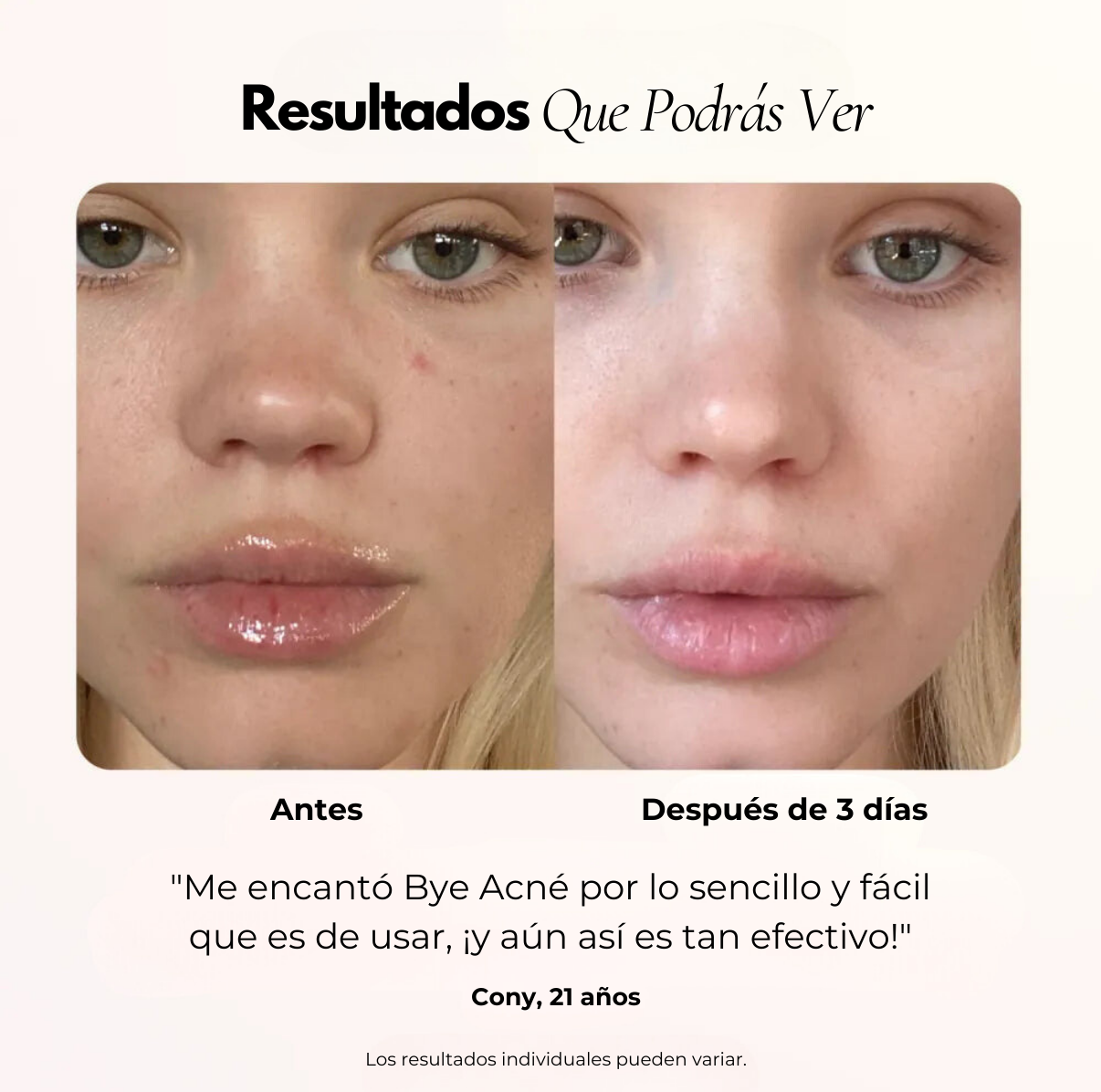 Bye Acné QSKIN fototerapia LED elimina bacterias del acné