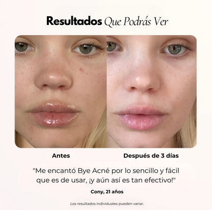 Bye Acné QSKIN fototerapia LED elimina bacterias del acné